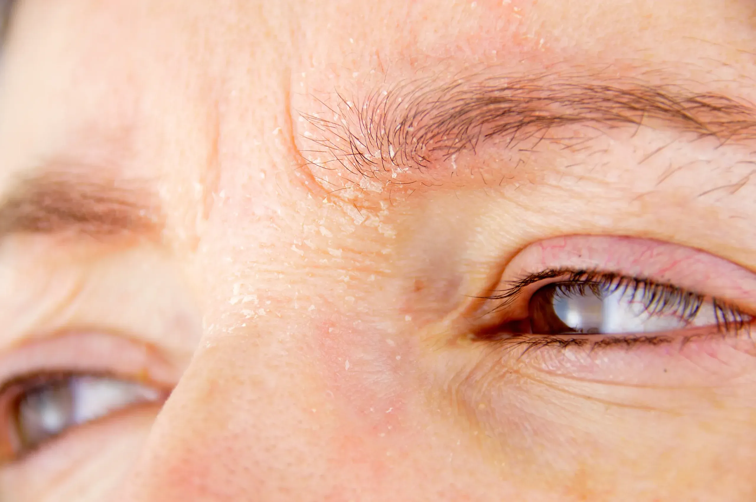 Atopy Skin