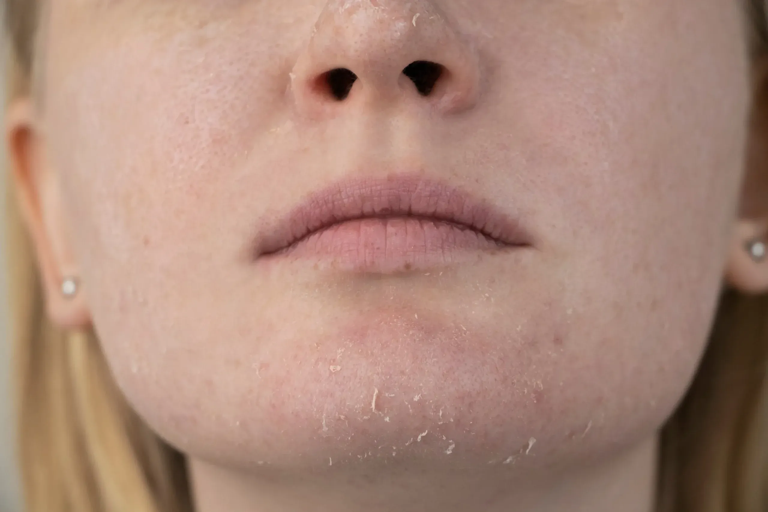 Atopy Skin