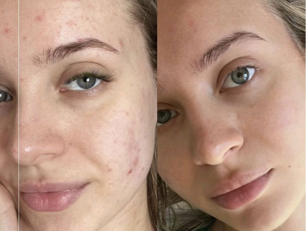 Acne Skin