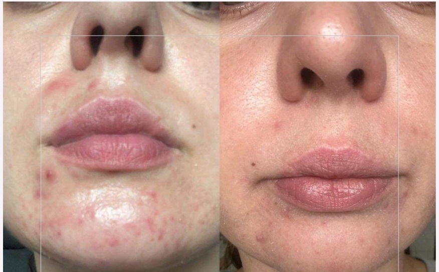 Acne Skin