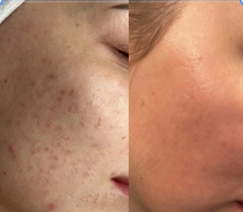 Hormonal Acne Skin