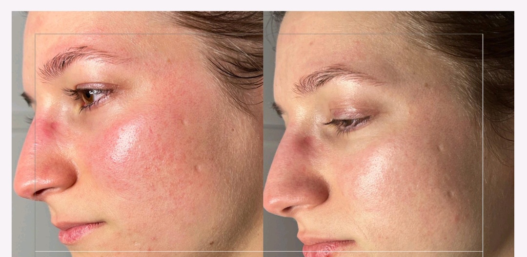 Rosacea Set