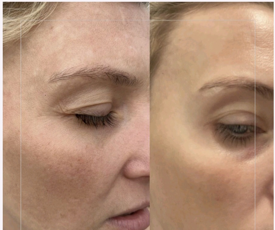 Skin Anti Pigmentation