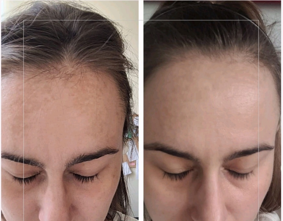 Skin Anti Pigmentation