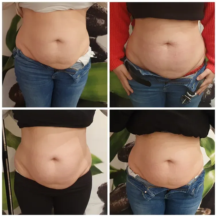 Carboxytherapy for the body, before and after, result 17
