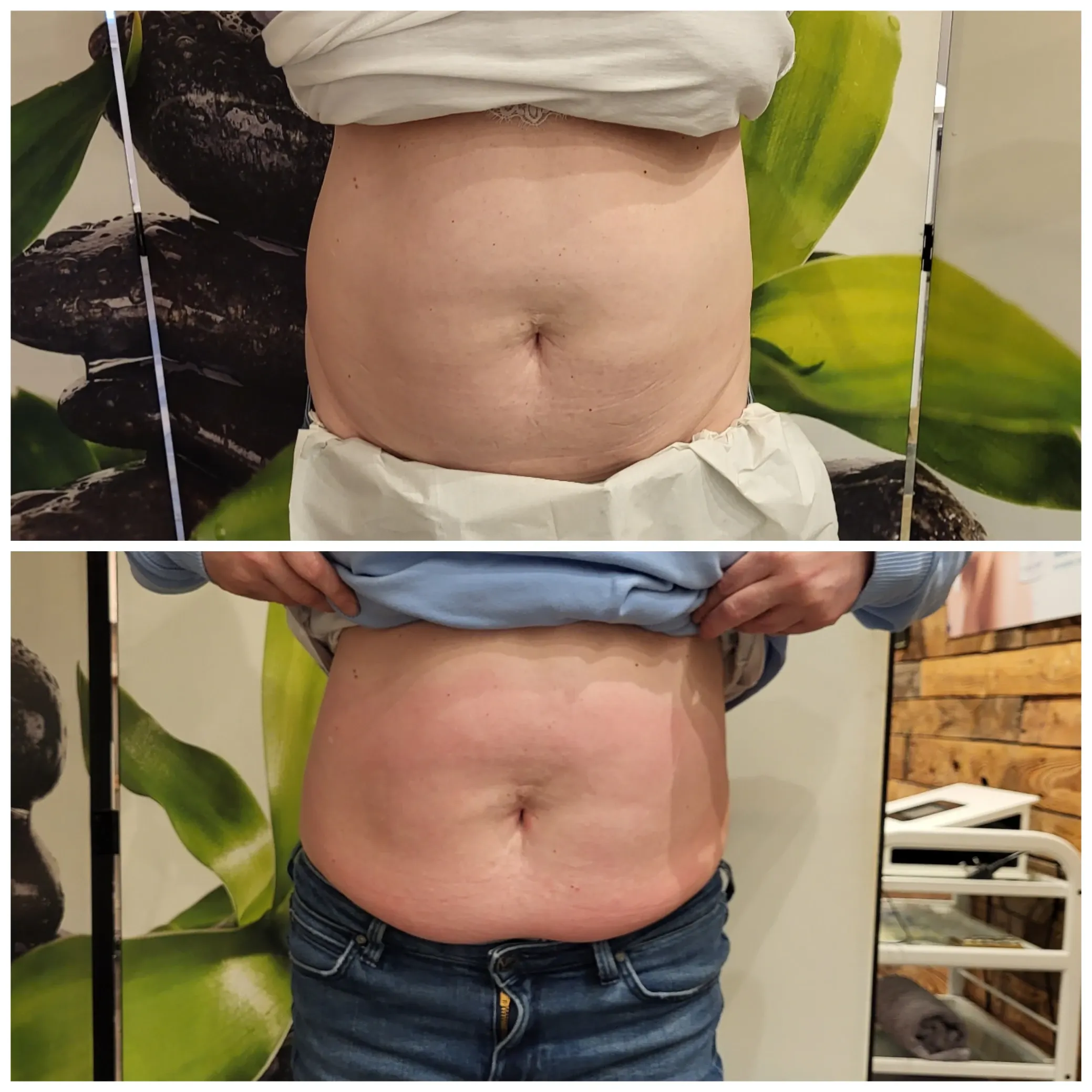 Carboxytherapy for the body, before and after, result 9
