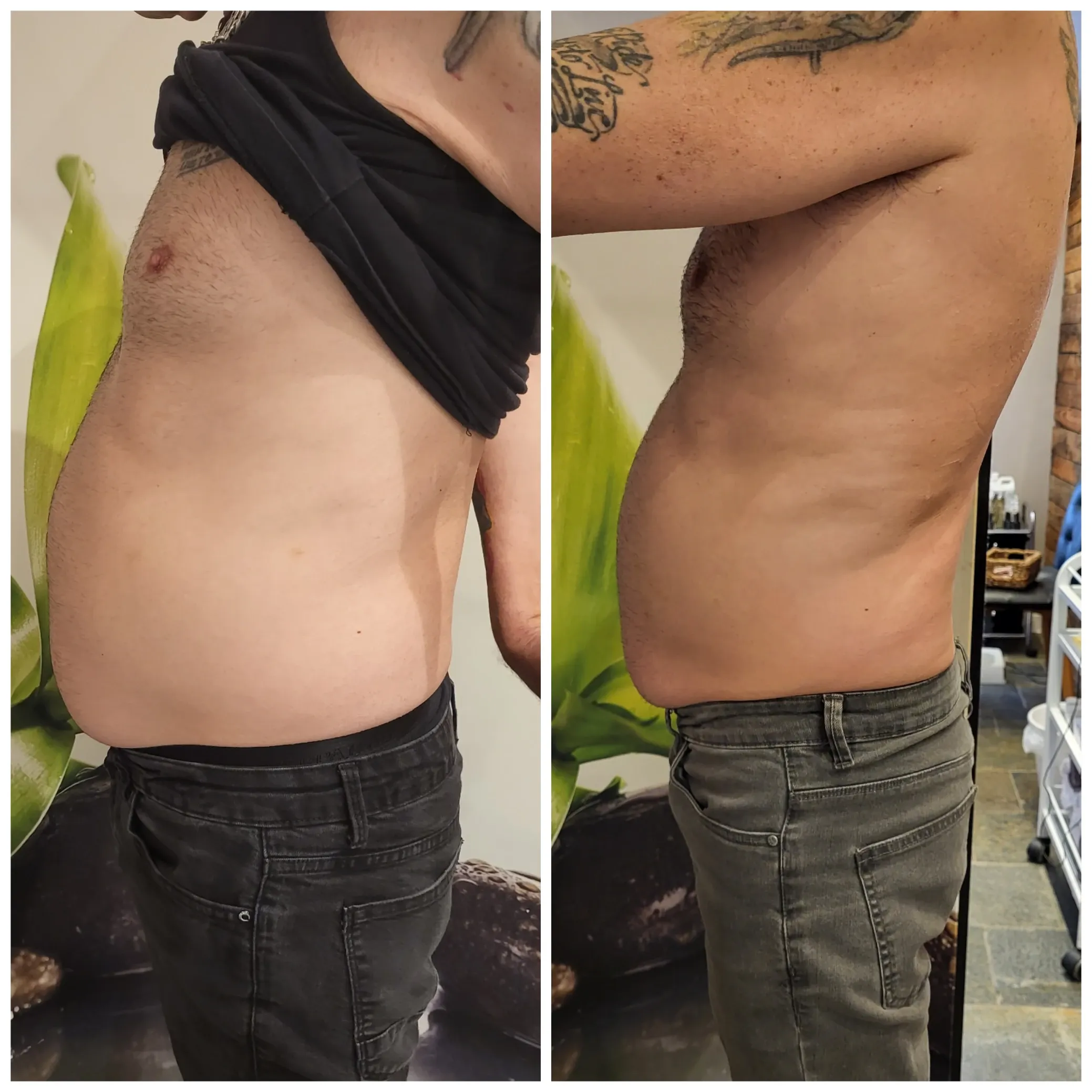Carboxytherapy for the body, before and after, result 8