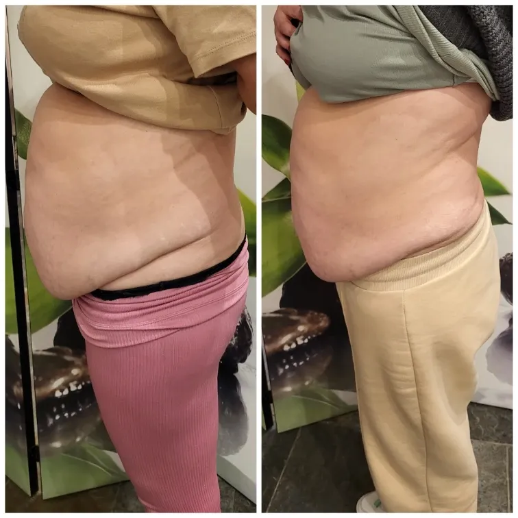 Carboxytherapy for the body, before and after, result 3