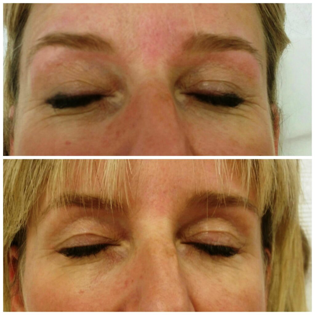 Carboxytherapy, before and after, result 1