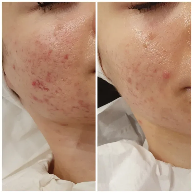 Desincrustation, before and after, result 1