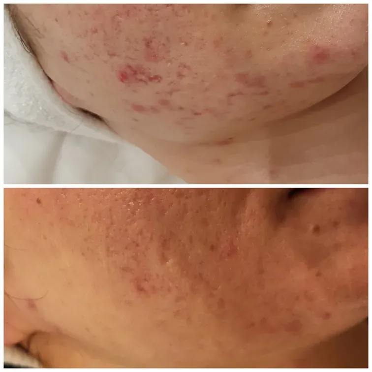 Desincrustation, before and after, result 4