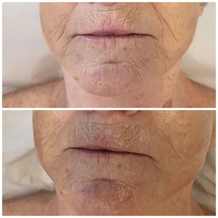 Hydrofacial, before and after, result 27