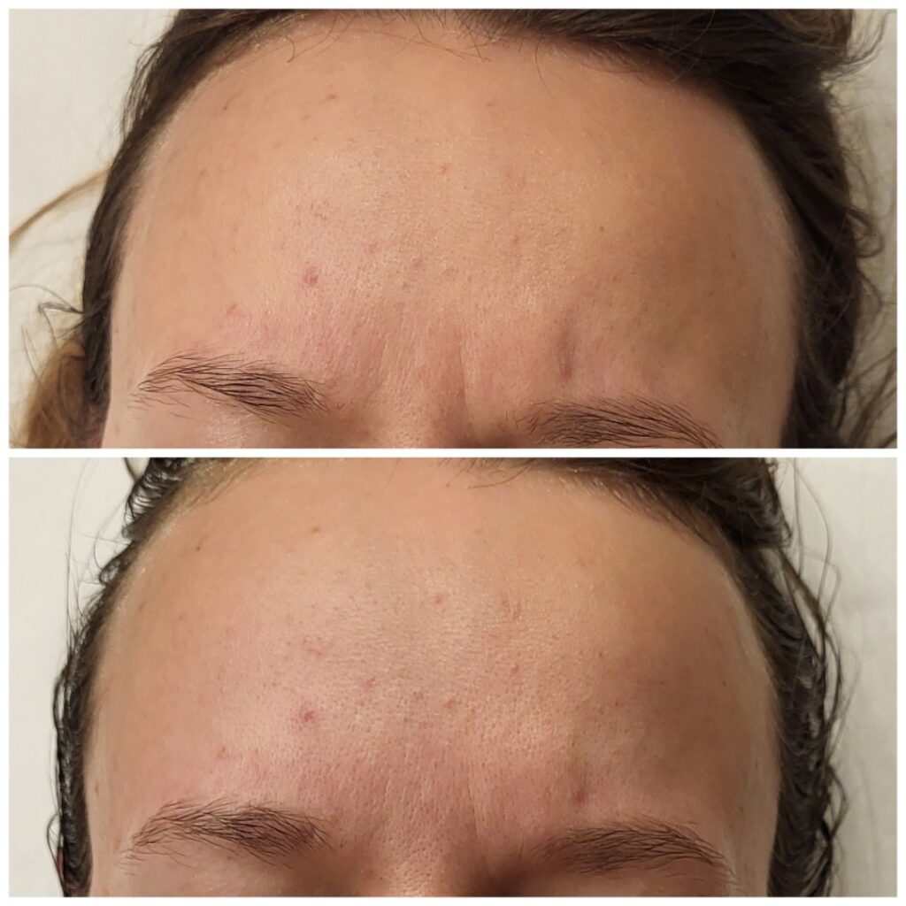 Kobido Up Massage, before and after, result 4