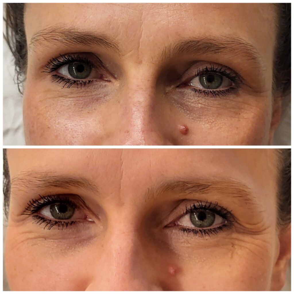 Kobido Up Massage, before and after, result 3