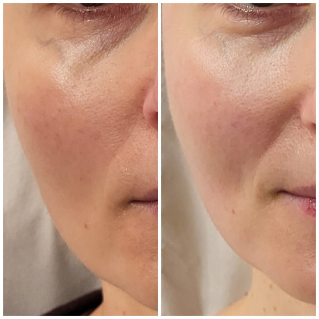 Kobido Up Massage, before and after, result 2