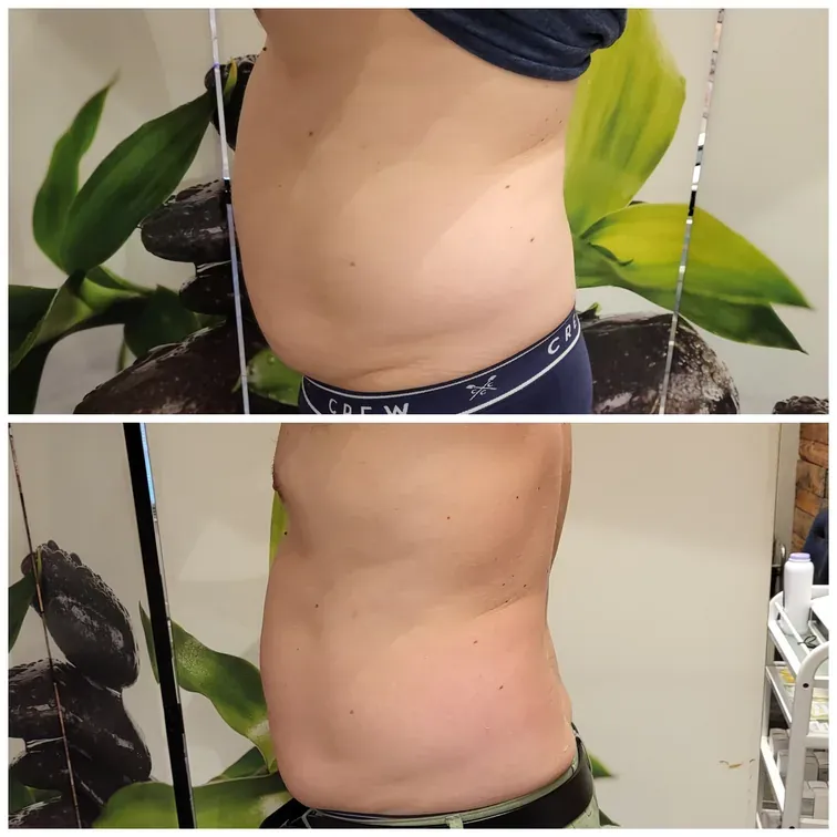 Radiofrequency Microneedling for the body, before and after, result 8