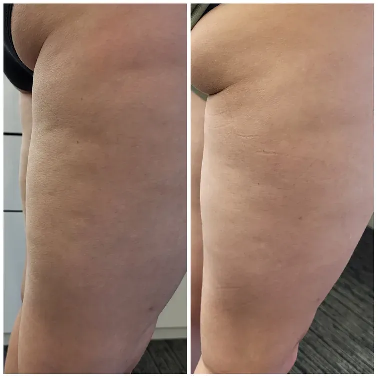 Radiofrequency Microneedling for the body, before and after, result 13