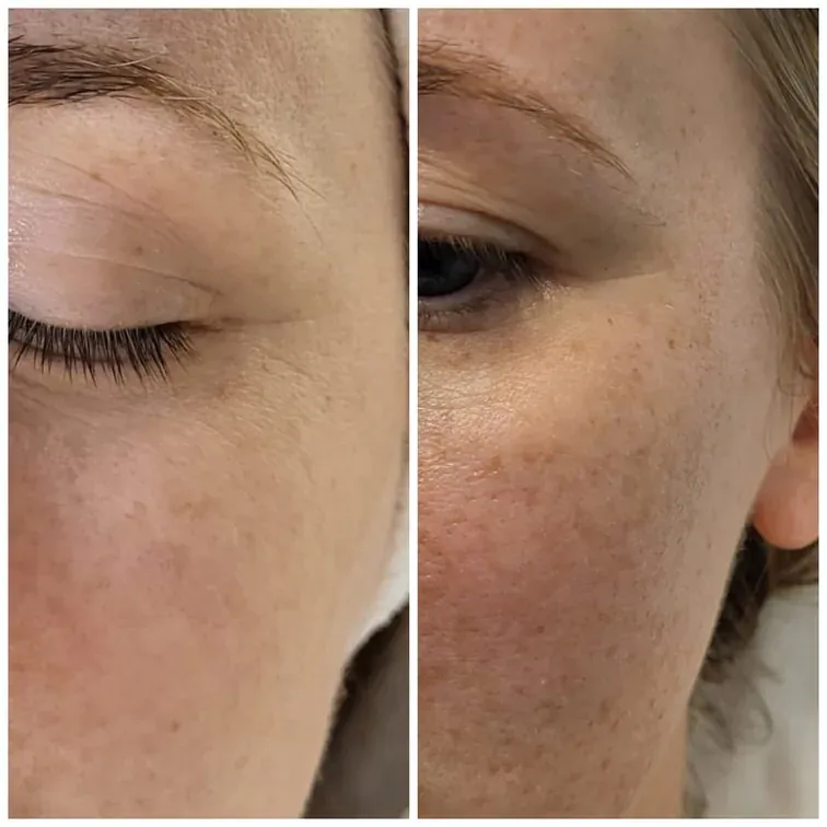 Radiofrequency Microneedling, before and after, result 1