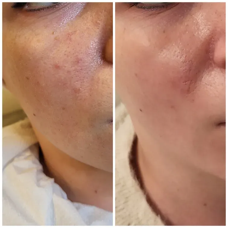 Radiofrequency Microneedling, before and after, result 8