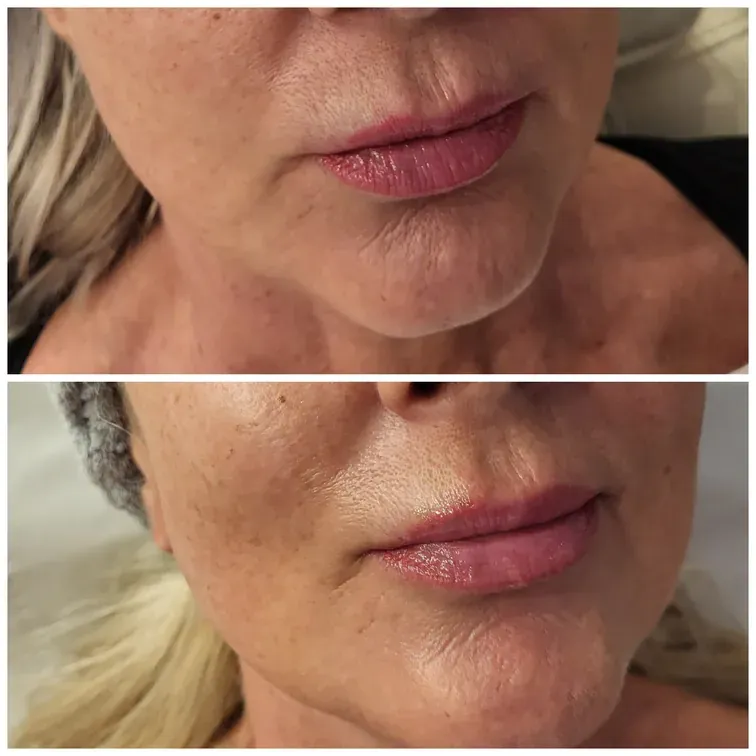Radiofrequency Microneedling, before and after, result 11