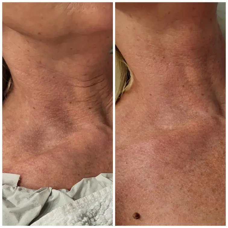 Radiofrequency Microneedling, before and after, result 12