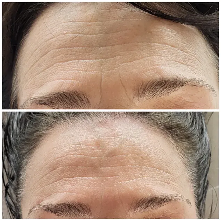 Radiofrequency Microneedling, before and after, result 16
