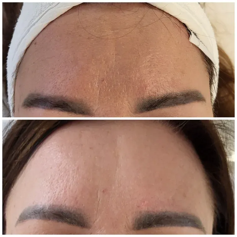Radiofrequency Microneedling, before and after, result 17