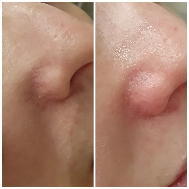Thermolysis, before and after, result 3