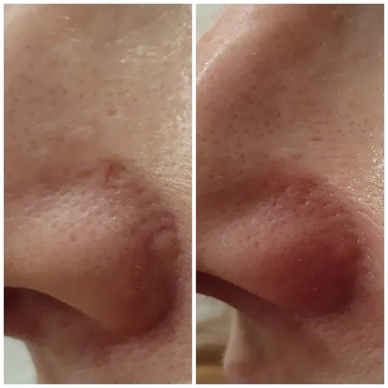 Thermolysis, before and after, result 4